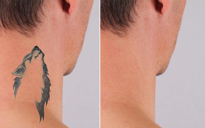 Tattoos are Easy to Remove Than You Think 