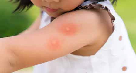 Amazing Things That You Should Know About Mosquito Bites