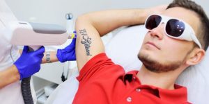 Everything you need to know about laser tattoo removal