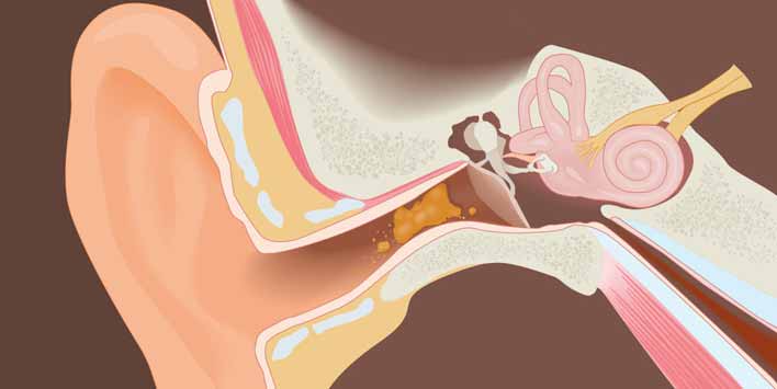 How do you remove deep ear wax