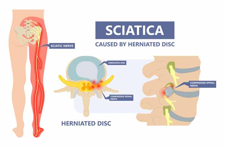 How to Relieve Sciatica Pain While Driving