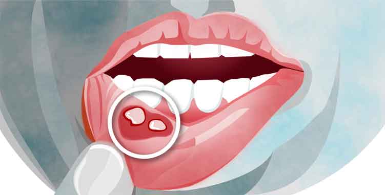 How to Relieve the Pain of Mouth Ulcers